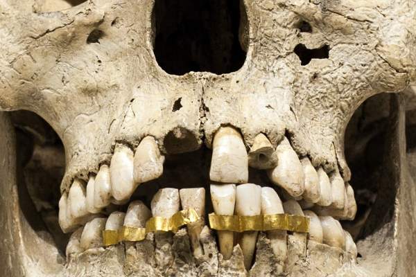 کاربرد طلا در دندانپزشکی
